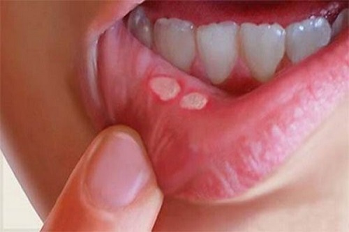 Cách chữa nhiệt miệng nhanh nhất bạn đã biết chưa?