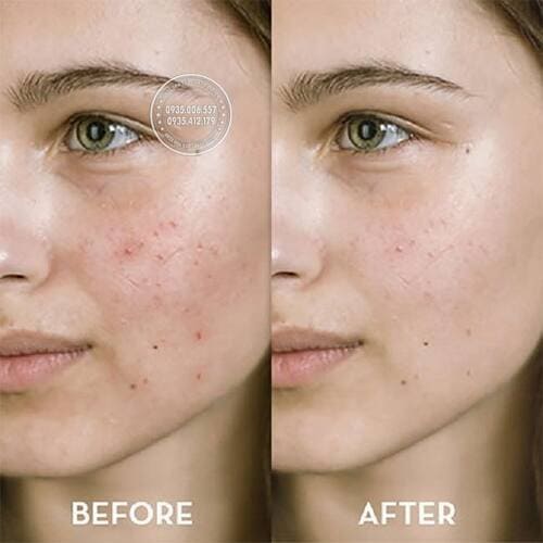 kem-tri-mun-neutrogena-spot-acne-treatment-reivew1